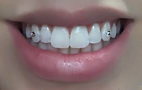 Swarovski® Tooth Crystals